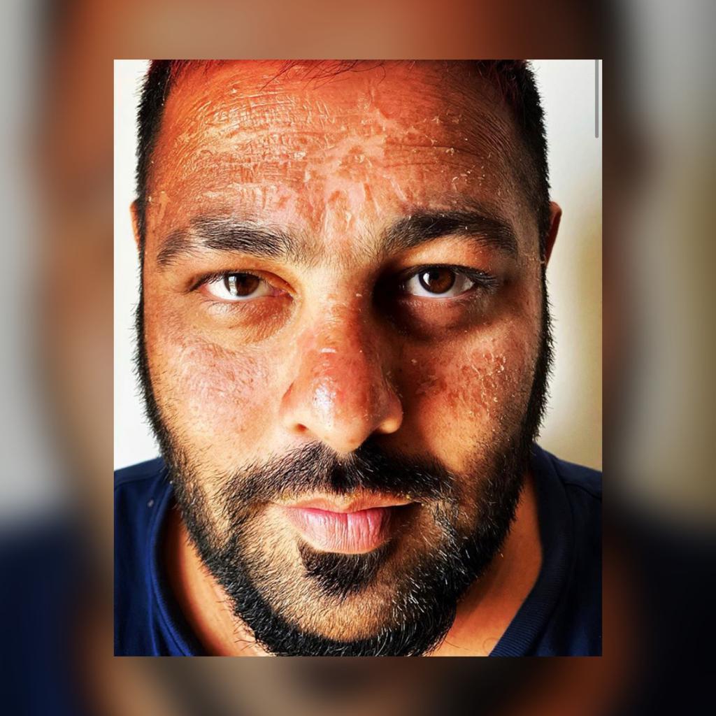 Badshah gets sunburnt; shares pictures from Maldives vacation