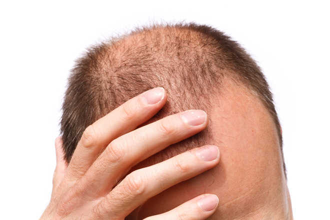 100 pc rise in hair loss complaints among Covid patients at Delhi hospital