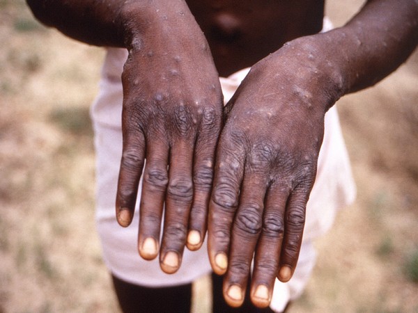 It's mpox now, not monkeypox, says WHO amid racism worries
