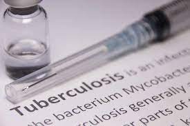 Over 1.5 million people had missed or delayed TB diagnosis in 2020 due to Covid: Study