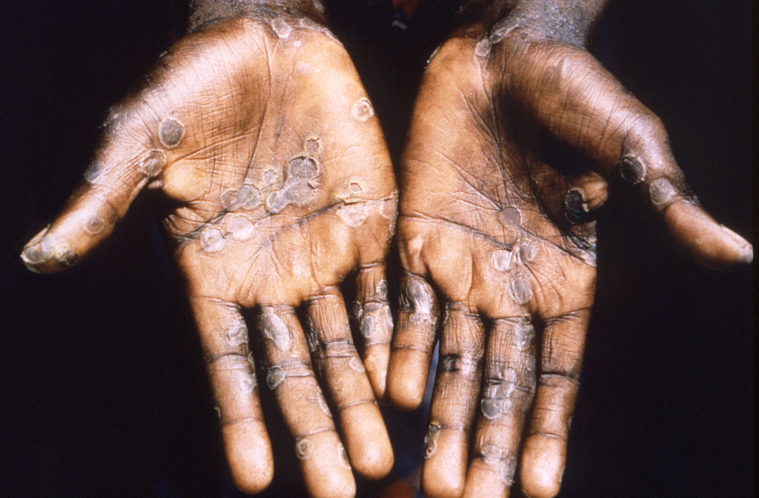 WHO expects more cases of monkeypox to emerge globally