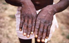 WHO: 200 monkeypox cases in 20 countries