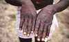 WHO asks countries to increase surveillance for Monkeypox
