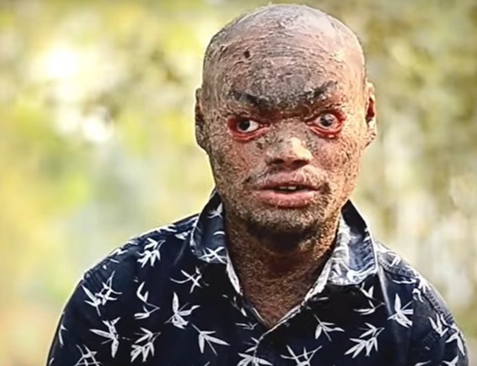 Watch: Bihar man suffers from an uncommon disease, sheds his skin every week like a snake