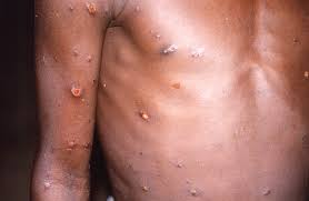 UK records 50 new cases of monkeypox