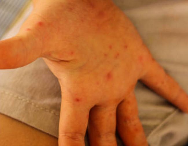 Hand, foot and mouth disease: Chandigarh Education Department appoints nodal person