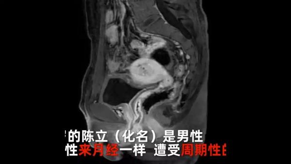 Chinese man with 'urinary issues' is intersex, with ovaries, uterus and has been menstruating for 20 years