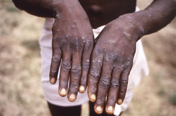8 monkeypox cases found, five with international travel history