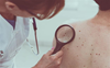 1 in 3 deaths from skin cancer due to working under the sun: UN agencies Geneva