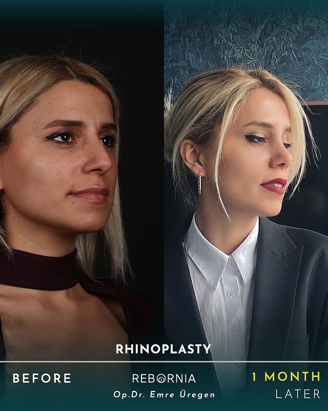 Top 15 Best Rhinoplasty (Nose Job) Doctors In Turkey – World