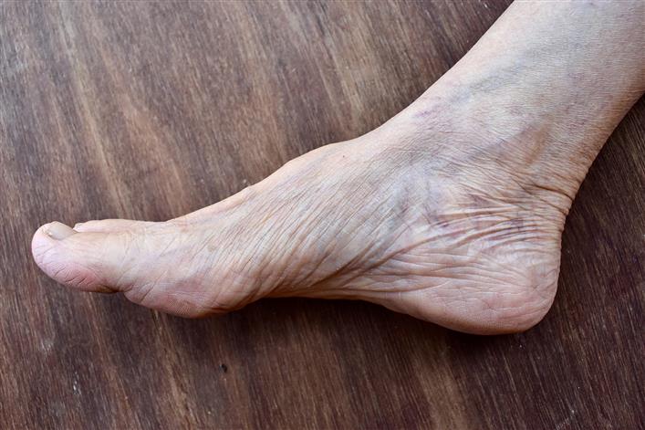Unusual case of ‘blue legs’ in long Covid patient seen, reveals Lancet study