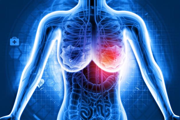 Scientists identify four new breast cancer risk genes