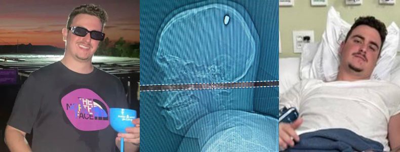 Brazilian medical student parties for 4 days with bullet in his head, he thought it was….