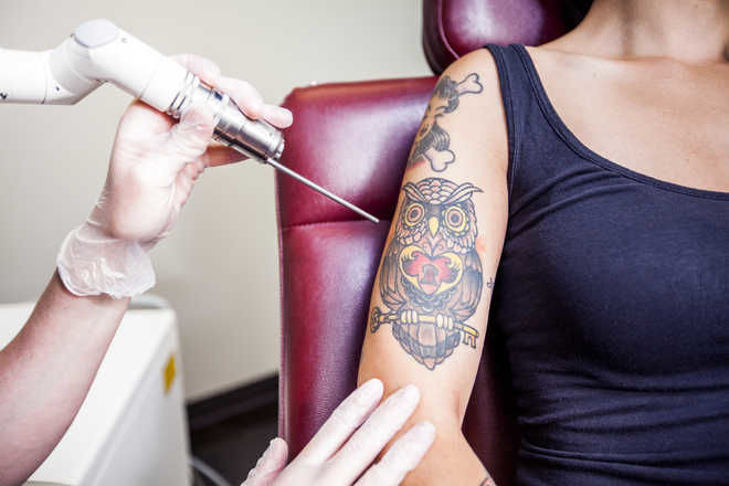 Tattoo regret? How to choose a removal service?