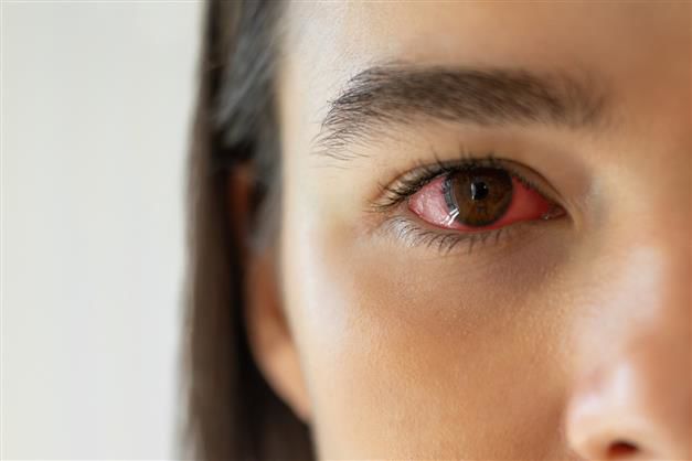 Study reports spike in Covid cases with dry, red, itchy eyes